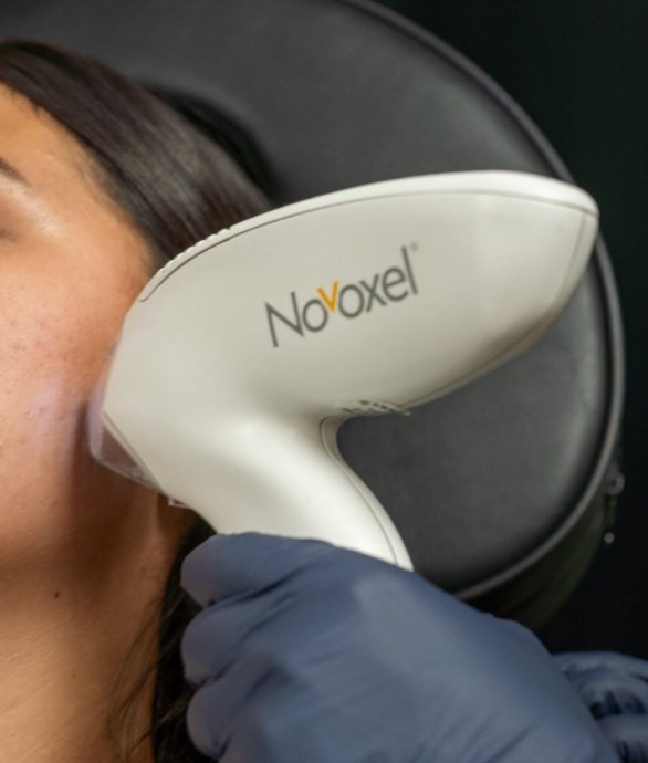 Tixel® Skin Resurfacing